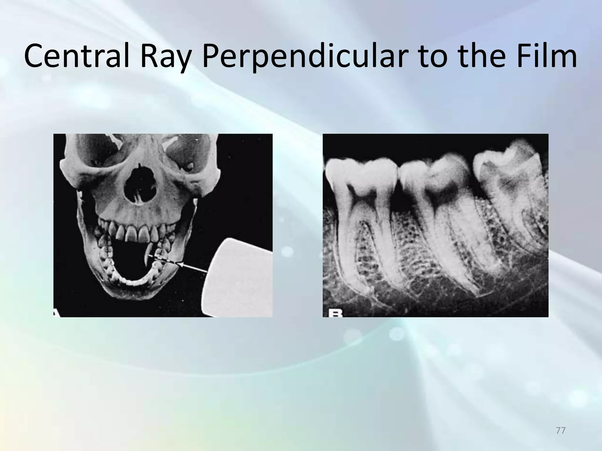 Central Ray Perpendicular to the Film




                                   77
 