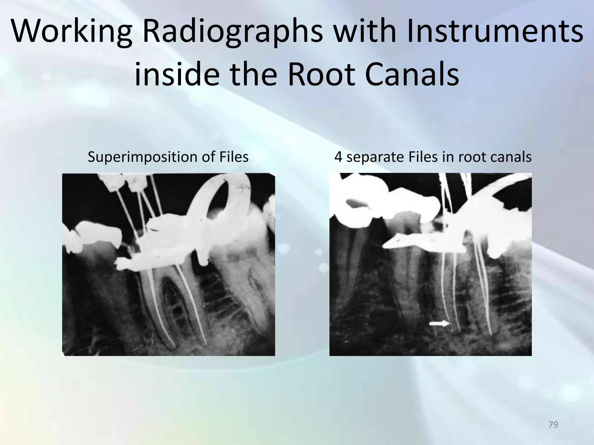 Working Radiographs with Instruments
       inside the Root Canals

    Superimposition of Files   4 separate Files in root canals




                                                                 79
 