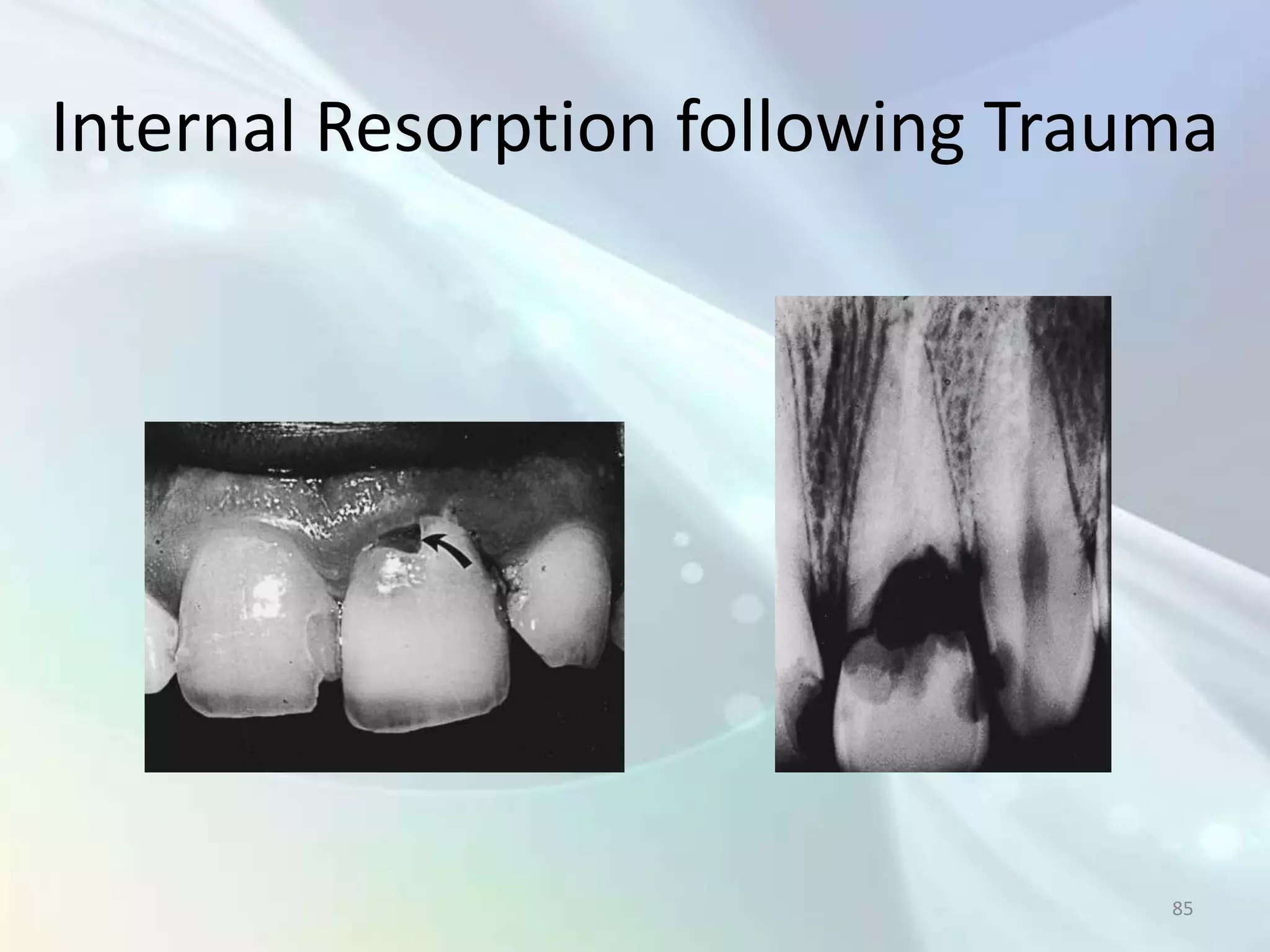 Internal Resorption following Trauma




                                  85
 