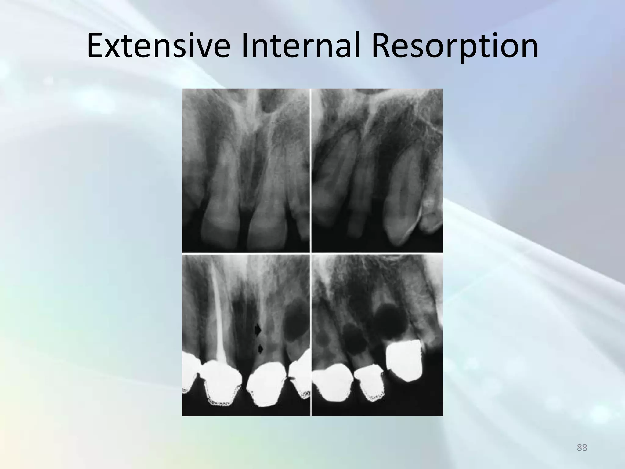 Extensive Internal Resorption




                                88
 