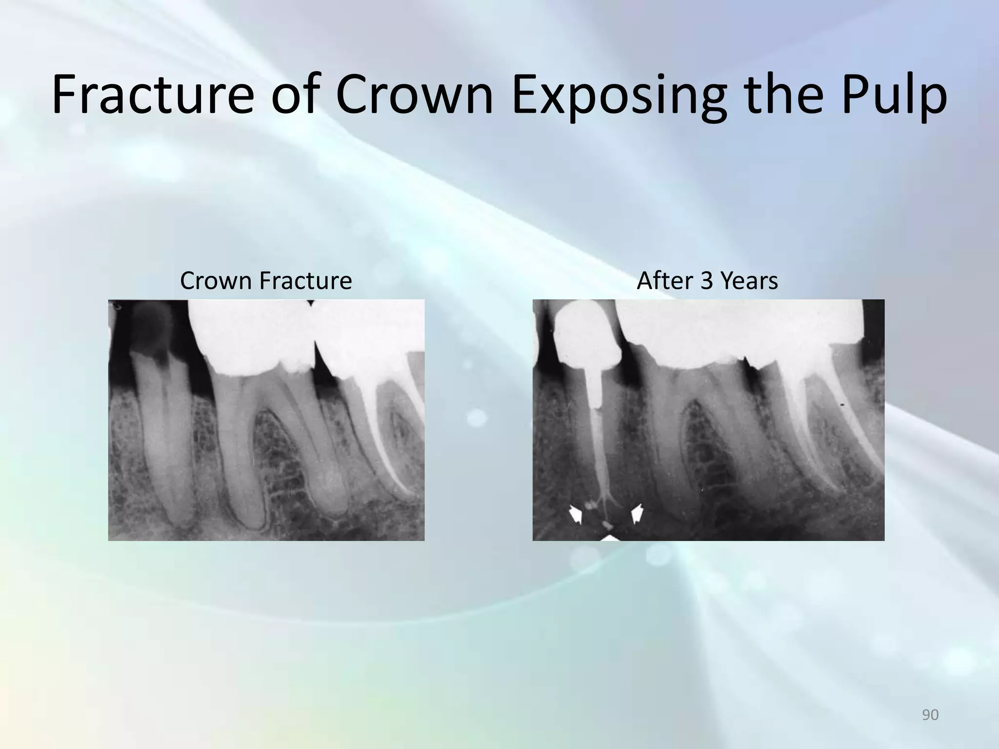 Fracture of Crown Exposing the Pulp

     Crown Fracture   After 3 Years




                                      90
 