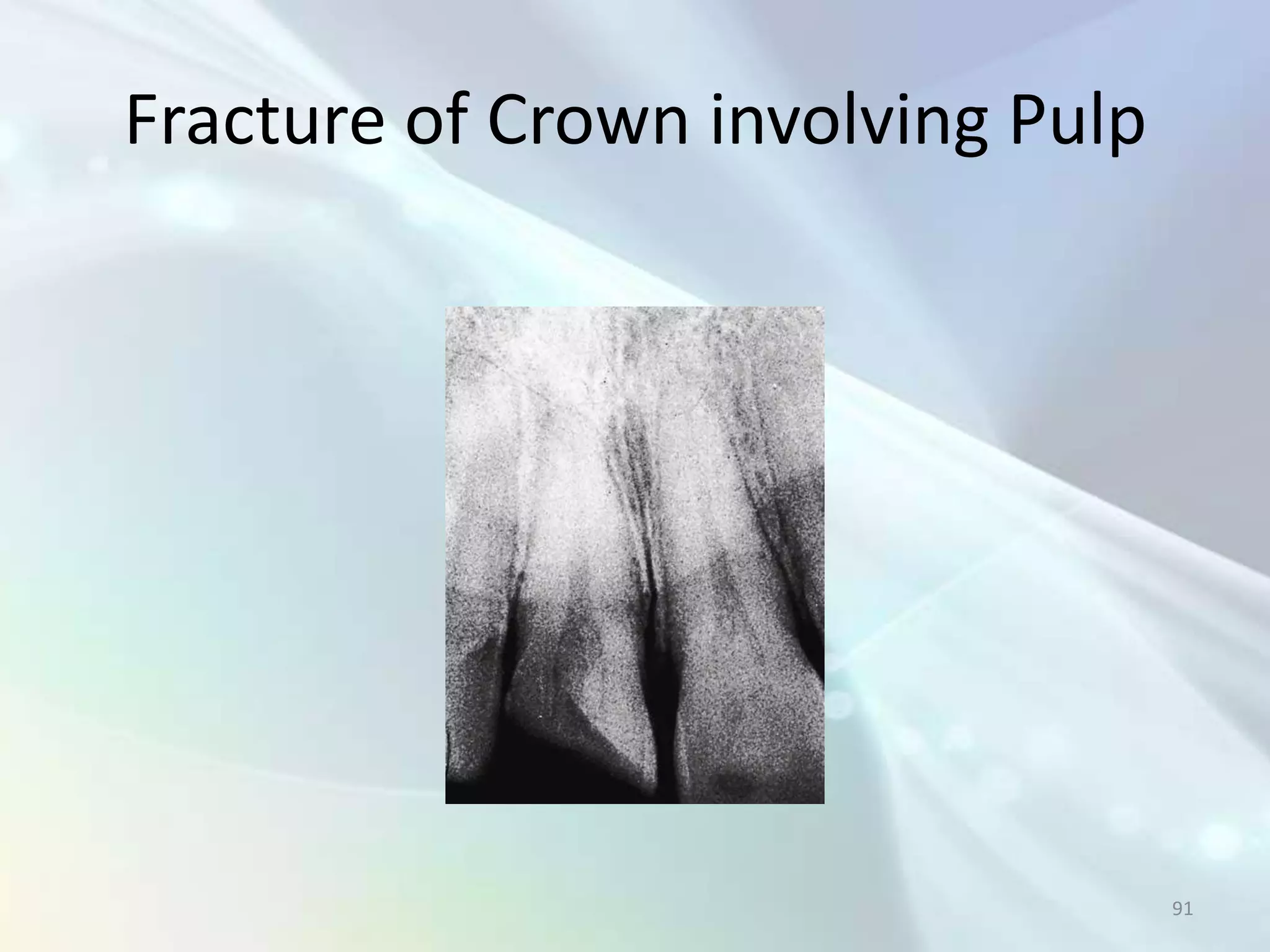 Fracture of Crown involving Pulp




                                   91
 