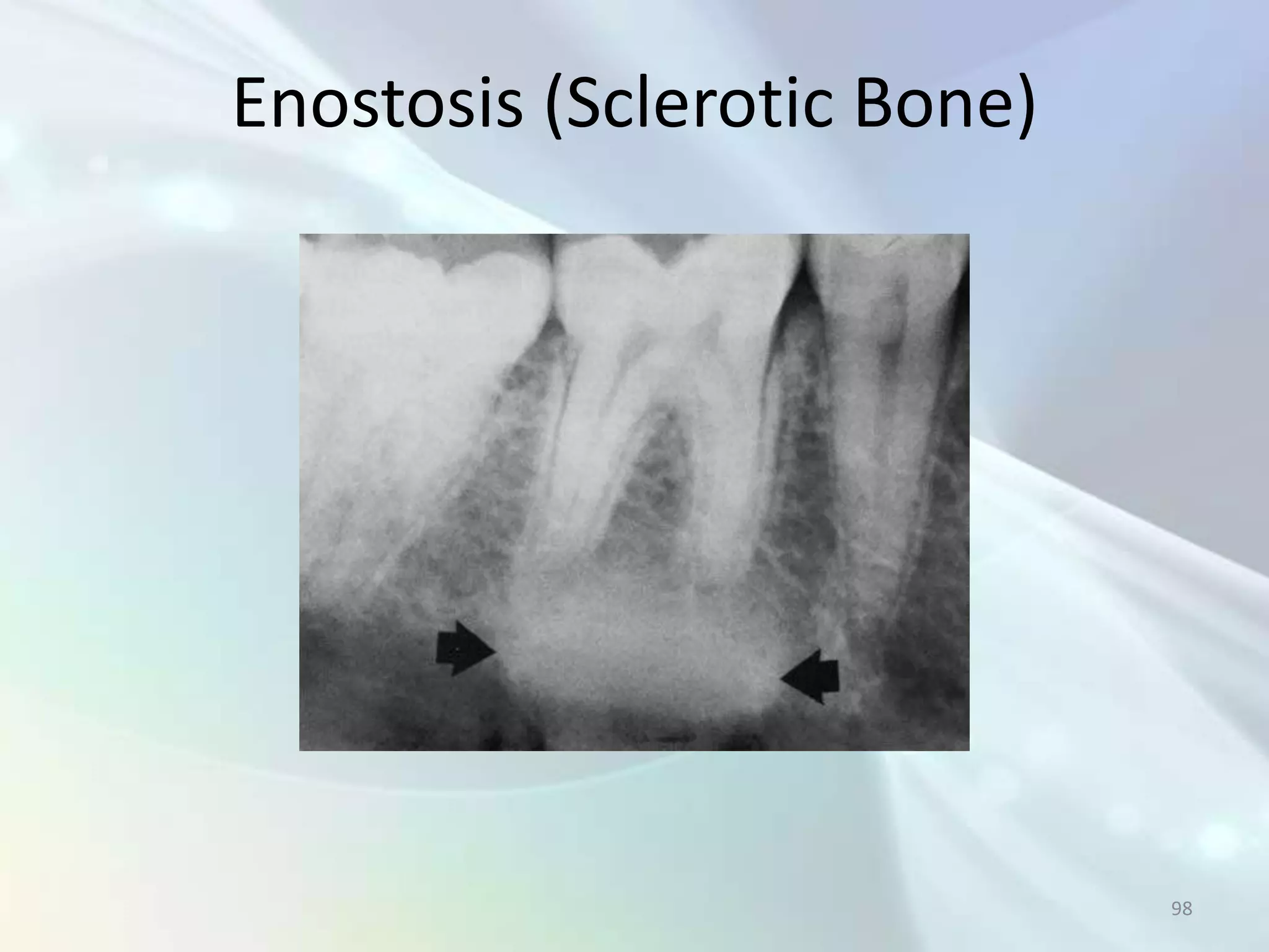 Enostosis (Sclerotic Bone)




                             98
 