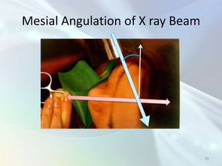 Messially Angulated Radiology in Endodontics | PPTX