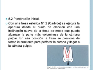  5.2 Penetración inicial.
 Con una fresa esférica N° 2 (Carbide) se ejecuta la
apertura desde el punto de elección con una
inclinación suave de la fresa de modo que pueda
alcanzar la parte más voluminosa de la cámara
pulpar. En esa posición la fresa se presiona de
forma intermitente para perforar la corona y llegar a
la cámara pulpar.
 