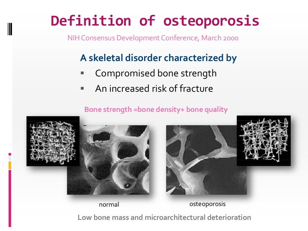 osteoporosis epidemiology and diagnosis