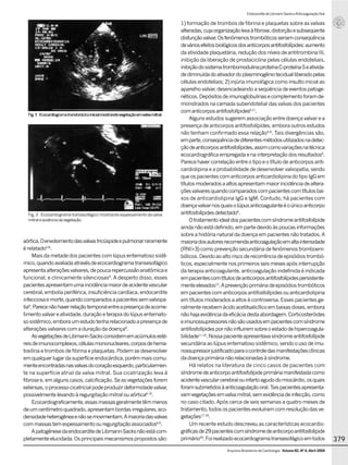 ArquivosBrasileirosdeCardiologia-Volume 82, Nº 4, Abril 2004
379
EndocarditedeLibmann-SackseAnticoagulaçãoOral
aórtica.Oenvolvimentodasvalvastricúspideepulmonarraramente
érelatado5-8
.
Mais da metade dos pacientes com lúpus eritematoso sistê-
mico,quandoavaliadaatravésdeecocardiogramatransesofágico
apresentaalteraçõesvalvares,depoucarepercussãoanatômicae
funcional, e clinicamente silenciosas9
. A despeito disso, esses
pacientesapresentamumaincidênciamaiordeacidentevascular
cerebral, embolia periférica, insuficiência cardíaca, endocardite
infecciosaemorte,quandocomparadosapacientessemvalvopa-
tia9
.Parecenãohaverrelaçãotemporalentreapresençadeacome-
timentovalvareatividade,duraçãoeterapiadolúpuseritemato-
sosistêmico,emboraumestudotenharelacionadoapresençade
alteraçõesvalvarescomaduraçãodadoença9
.
AsvegetaçõesdeLibmann-Sacksconsistememacúmulosesté-
reisdeimunocomplexos,célulasmononucleares,corposdehema-
toxilina e trombos de fibrina e plaquetas.Podem se desenvolver
emqualquerlugardasuperfícieendocárdica,porémmaiscomu-
menteencontradasnasvalvasdocoraçãoesquerdo,particularmen-
te na superfície atrial da valva mitral. Sua cicatrização leva à
fibrosee,emalgunscasos,calcificação.Seasvegetaçõesforem
extensas,oprocessocicatricialpodeproduzirdeformidadevalvar,
possivelmentelevandoàregurgitaçãomitralouaórtica6-10
.
Ecocardiograficamente,essasmassasgeralmentetêmmenos
deumcentímetroquadrado,apresentambordasirregulares,eco-
densidadeheterogêneaenãosemovimentam.Amaioriadasvalvas
commassastemespessamentoouregurgitaçãoassociados6,9
.
ApatogênesedaendocarditedeLibmann-Sacksnãoestácom-
pletamenteelucidada.Osprincipaismecanismospropostossão:
1) formação de trombos de fibrina e plaquetas sobre as valvas
alteradas,cujaorganizaçãolevaàfibrose,distorçãoesubseqüente
disfunçãovalvar.Osfenômenostrombóticosseriamconseqüência
deváriosefeitosbiológicosdosanticorposantifosfolípides:aumento
da atividade plaquetária, redução dos níveis de antitrombina III,
inibição da liberação de prostaciclina pelas células endoteliais,
inibiçãodosistematrombomodulinaproteínaC-proteínaSeativida-
dediminuídadoativadordoplasminogêniotecidualliberadopelas
célulasendoteliais;2)injúriaimunológicacomoinsultoinicialao
aparelho valvar,desencadeando a seqüência de eventos patoge-
néticos.Depósitosdeimunoglobulinasecomplementoforamde-
monstrados na camada subendotelial das valvas dos pacientes
comanticorposantifosfolípides6,11
.
Alguns estudos sugerem associação entre doença valvar e a
presença de anticorpos antifosfolípides, embora outros estudos
não tenham confirmado essa relação5,6
. Tais divergências são,
emparte,conseqüênciadediferentesmétodosutilizadosnadetec-
çãodeanticorposantifosfolípides,assimcomovariaçõesnatécnica
ecocardiográficaempregadaenainterpretaçãodosresultados6
.
Parece haver correlação entre o tipo e o título de anticorpos anti-
cardiolipina e a probabilidade de desenvolver valvopatia, sendo
queospacientescomanticorposanticardiolipinadotipoIgGem
títulosmoderadosaaltosapresentammaiorincidênciadealtera-
çõesvalvaresquandocomparadoscompacientescomtítulosbai-
xos de anticardiolipina IgG e IgM. Contudo, há pacientes com
doençavalvarnosquaisolúpusanticoagulanteéoúnicoanticorpo
antifosfolípidesdetectado6
.
Otratamentoidealdospacientescomsíndromeantifosfolípide
aindanãoestádefinido,empartedevidoàspoucasinformações
sobre a história natural da doença em pacientes não tratados. A
maioriadosautoresrecomendaanticoagulaçãoemaltaintensidade
(RNI>3) como prevenção secundária de fenômenos tromboem-
bólicos.Devidoaoaltoriscoderecorrênciadeepisódiostrombó-
ticos,especialmentenosprimeirosseismesesapósinterrupção
da terapia anticoagulante, anticoagulação indefinida é indicada
empacientescomtítulosdeanticorposantifosfolípidespersistente-
menteelevados12
.Aprevençãoprimáriadeepisódiostrombóticos
empacientescomanticorposantifosfolípidesouanticardiolipina
em títulos moderados a altos é controversa. Esses pacientes ge-
ralmenterecebemácidoacetilsalicílicoembaixasdoses,embora
nãohajaevidênciadaeficáciadestaabordagem.Corticosteróides
eimunossupressoresnãosãousadosempacientescomsíndrome
antifosfolípidespornãoinfluiremsobreoestadodehipercoagula-
bilidade11-16
.Nossapacienteapresentavasíndromeantifosfolípide
secundáriaaolúpuseritematososistêmico,sendoousodeimu-
nossupressorjustificadoparaocontroledasmanifestaçõesclínicas
dadoençaprimárianãorelacionadasàsíndrome.
Há relatos na literatura de cinco casos de pacientes com
síndromedeanticorpoantifosfolípideprimáriamanifestadacomo
acidentevascularcerebralouinfartoagudodomiocárdio,osquais
foramsubmetidosàanticoagulaçãooral.Taispacientesapresenta-
vamvegetaçõesemvalvamitral,semevidênciadeinfecção,como
no caso citado. Após cerca de seis semanas a quatro meses de
tratamento,todosospacientesevoluíramcomresoluçãodasve-
getações17-19
.
Um recente estudo descreveu as características ecocardio-
gráficasde29pacientescomsíndromedeanticorpoantifosfolípide
primário20
.Foirealizadoecocardiogramatransesofágicoemtodos
Fig.1-Ecocardiogramatranstorácicoinicialmostrandovegetaçãoemvalvamitral.
Fig. 2 - Ecocardiograma transesofágico mostrando espessamento da valva
mitraleausênciadavegetação.
Fig.1-Ecocardiogramatranstorácicoinicialmostrandovegetaçãoemvalvamitral.
 