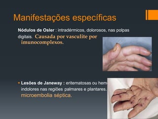 Manifestações específicas
Nódulos de Osler : intradérmicos, dolorosos, nas polpas
digitais. Causada por vasculite por
imunocomplexos.
 Lesões de Janeway : eritematosas ou hemorrágicas
indolores nas regiões palmares e plantares. Por
microembolia séptica.
 