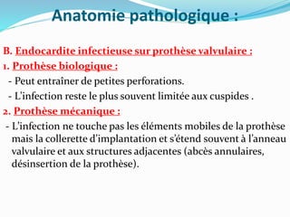Anatomie pathologique :
B. Endocardite infectieuse sur prothèse valvulaire :
1. Prothèse biologique :
- Peut entraîner de petites perforations.
- L’infection reste le plus souvent limitée aux cuspides .
2. Prothèse mécanique :
- L’infection ne touche pas les éléments mobiles de la prothèse
mais la collerette d’implantation et s’étend souvent à l’anneau
valvulaire et aux structures adjacentes (abcès annulaires,
désinsertion de la prothèse).
 
