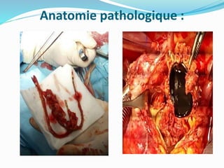 Anatomie pathologique :
 