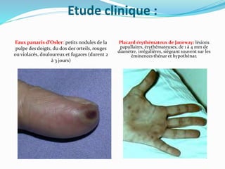 Etude clinique :
Faux panaris d’Osler: petits nodules de la
pulpe des doigts, du dos des orteils, rouges
ou violacés, douloureux et fugaces (durent 2
à 3 jours)
Placard érythémateux de Janeway: lésions
papullaires, érythémateuses, de 1 à 4 mm de
diamètre, irrégulières, siégeant souvent sur les
éminences thénar et hypothénar.
 