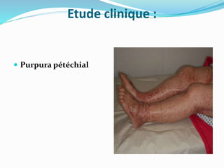 Etude clinique :
 Purpura pétéchial
 