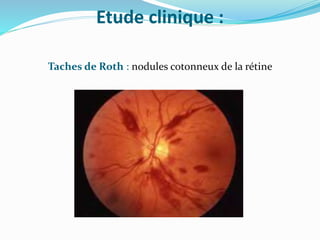Etude clinique :
Taches de Roth : nodules cotonneux de la rétine
 