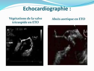 Echocardiographie :
Végétations de la valve
tricuspide en ETO
Abcès aortique en ETO
 