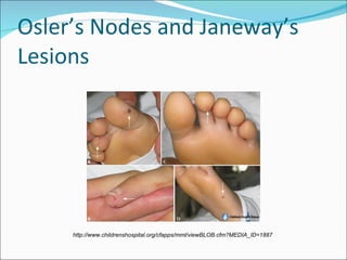Osler’s Nodes and Janeway’s Lesions http://www.childrenshospital.org/cfapps/mml/viewBLOB.cfm?MEDIA_ID=1887 