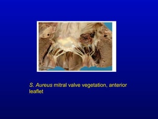 S. Aureus mitral valve vegetation, anterior
leaflet
 