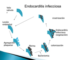 Velo      Endocarditis infecciosa
    valvula
    r

                                         cicatrización

Lesión
endotelial

                                            Endocarditis
                                            infecciosa
                                            (vegetación)


 Agregación
 plaquetar      fibrina                 colonización




                          Bacteriemia
 