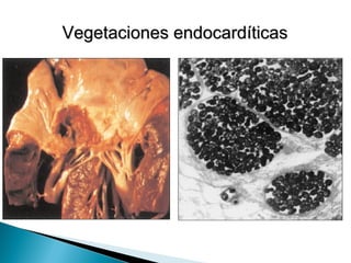 Vegetaciones endocardíticas
 