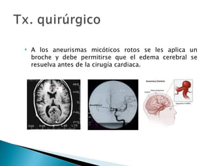    A los aneurismas micóticos rotos se les aplica un
    broche y debe permitirse que el edema cerebral se
    resuelva antes de la cirugía cardiaca.
 