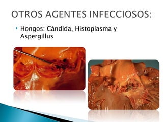    Hongos: Cándida, Histoplasma y
    Aspergillus
 