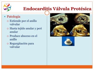 Endocarditis Válvula Protésica
 Patología
    Extiende por el anillo
     valvular
    Hasta tejido anular y peri
     anular
    Produce absceso en el
     anillo
    Regurgitación para
     valvular
 