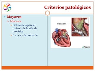 Criterios patológicos

 Mayores
    Abscesos
      Dehiscencia parcial
       reciente de la válvula
       protésica
      Ins. Valvular reciente
 