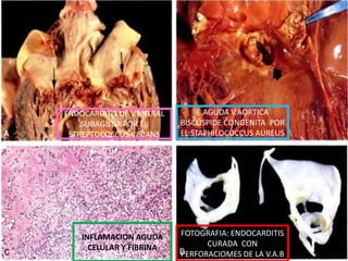 ENDOCARDITIS DE V.MITRAL        E.AGUDA V.AORTICA
    SUBAGUDA POR EL        BISCÚSPIDE CONGENITA POR
 STREPTOCOCCUS VIRIANS     EL STAPHILOCOCCUS AUREUS




    INFLAMACION AGUDA      FOTOGRAFIA: ENDOCARDITIS
      CELULAR Y FIBRINA          CURADA CON
                           PERFORACIOMES DE LA V.A.B
 