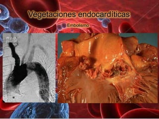Vegetaciones endocardíticas
          Embolismo
 
