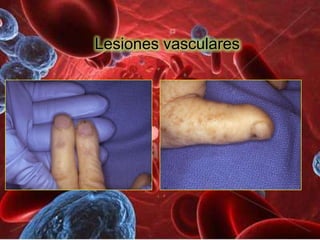 Lesiones vasculares
 