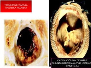 TROMBOSIS DE VÁLVULA
 PROSTÉSICA MECÁNICA
                       ´CAL




                                  CALCIFICACIÓN CON DESGARRO
                              SEGUNDARIO DE UNA VÁLVULA CARDIACA
                                          BIPROSTÉSICA
 