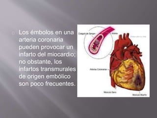 Los émbolos en una
arteria coronaria
pueden provocar un
infarto del miocardio;
no obstante, los
infartos transmurales
de origen embólico
son poco frecuentes.
 