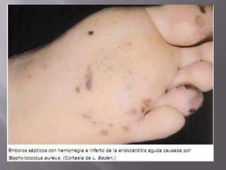 Se producen a menudo microabscesos en
encéfalo y meninges en caso de endocarditis
por S. aureus; son poco frecuentes los
abscesos que se pueden drenar por medios
quirúrgicos.
 