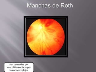 Manchas de Roth
son causadas por
vasculitis mediada por
inmunocomplejos
 
