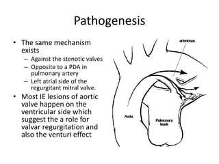 Pathogenesis 
• The same mechanism 
exists 
– Against the stenotic valves 
– Opposite to a PDA in 
pulmonary artery 
– Left atrial side of the 
regurgitant mitral valve. 
• Most IE lesions of aortic 
valve happen on the 
ventricular side which 
suggest the a role for 
valvar regurgitation and 
also the venturi effect 
 