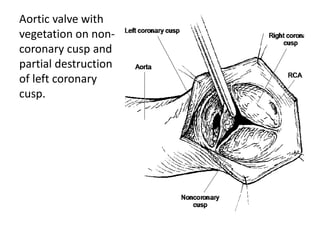 Aortic valve with 
vegetation on non-coronary 
cusp and 
partial destruction 
of left coronary 
cusp. 
 