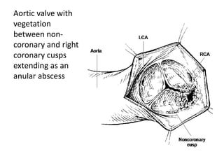 Aortic valve with 
vegetation 
between non-coronary 
and right 
coronary cusps 
extending as an 
anular abscess 
 