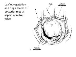 Leaflet vegetation 
and ring abscess of 
posterior medial 
aspect of mitral 
valve 
 