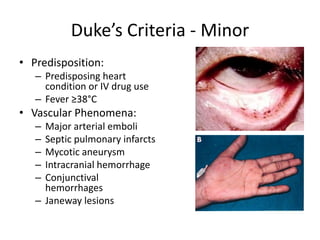 Duke’s Criteria - Minor 
• Predisposition: 
– Predisposing heart 
condition or IV drug use 
– Fever ≥38°C 
• Vascular Phenomena: 
– Major arterial emboli 
– Septic pulmonary infarcts 
– Mycotic aneurysm 
– Intracranial hemorrhage 
– Conjunctival 
hemorrhages 
– Janeway lesions 
 