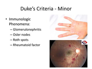 Duke’s Criteria - Minor 
• Immunologic 
Phenomena: 
– Glomerulonephritis 
– Osler nodes 
– Roth spots 
– Rheumatoid factor 
 