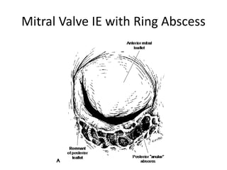 Mitral Valve IE with Ring Abscess 
 
