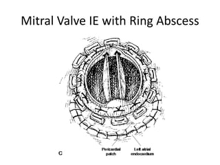 Mitral Valve IE with Ring Abscess 
 