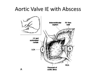 Aortic Valve IE with Abscess 
 