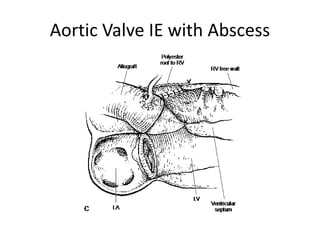 Aortic Valve IE with Abscess 
 