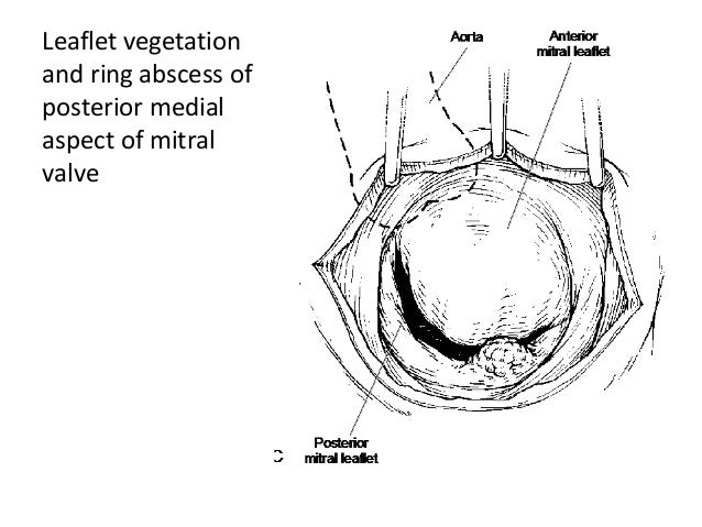 Valve Ring Abscess Valve Ring Abscess