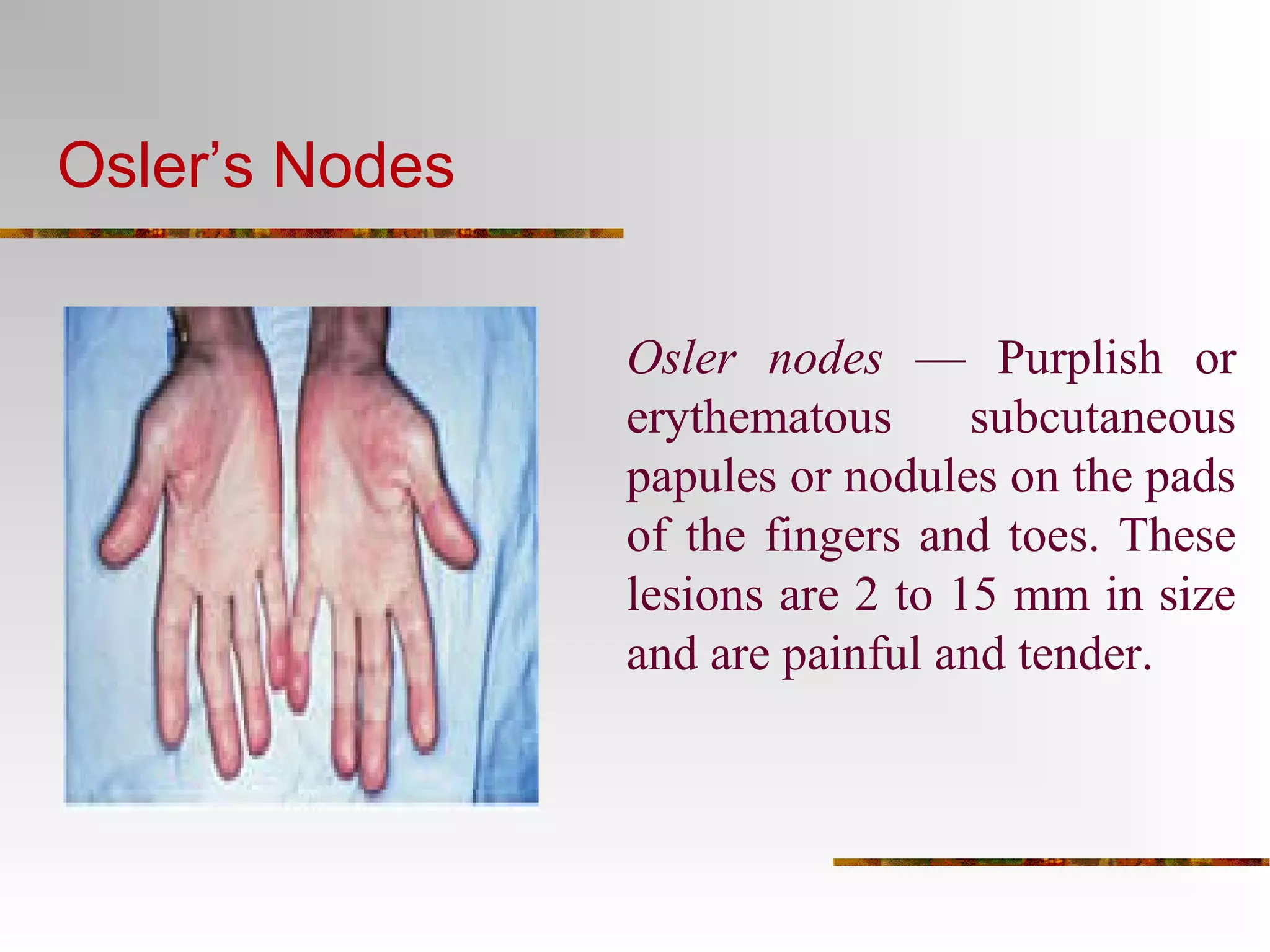 Osler’s Nodes 
Osler nodes — Purplish or 
erythematous subcutaneous 
papules or nodules on the pads 
of the fingers and toes. These 
lesions are 2 to 15 mm in size 
and are painful and tender. 
 