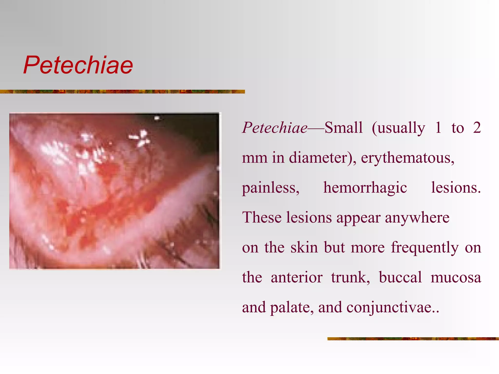Petechiae 
Petechiae—Small (usually 1 to 2 
mm in diameter), erythematous, 
painless, hemorrhagic lesions. 
These lesions appear anywhere 
on the skin but more frequently on 
the anterior trunk, buccal mucosa 
and palate, and conjunctivae.. 
 