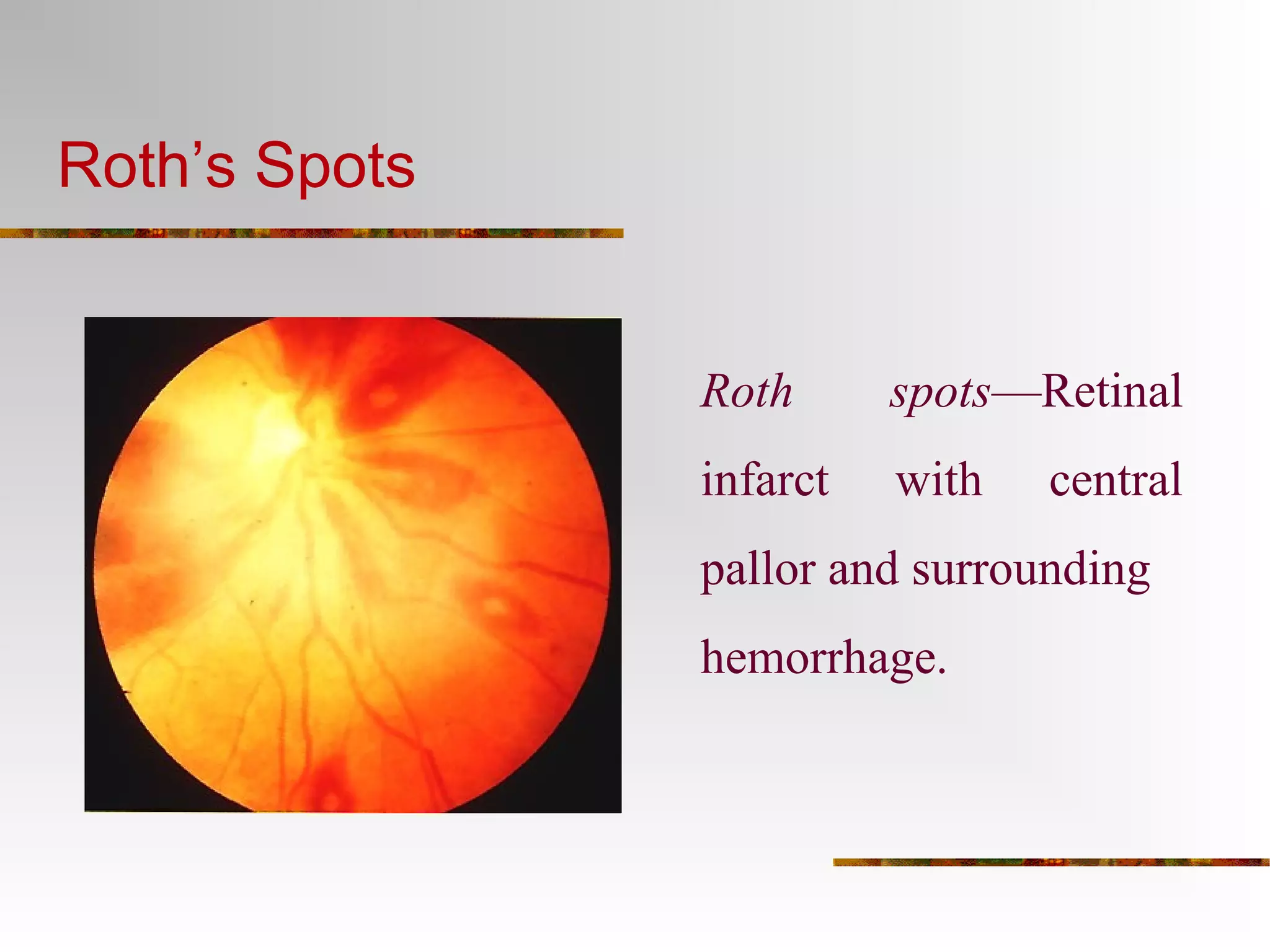 Roth’s Spots 
Roth spots—Retinal 
infarct with central 
pallor and surrounding 
hemorrhage. 
 