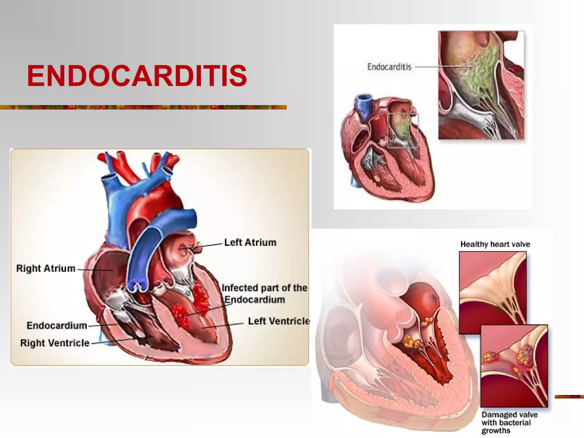 ENDOCARDITIS 
 