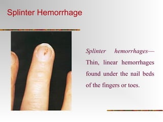 Splinter Hemo Endocarditis | PPT