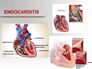 Endocarditis | PPT